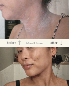 Discover how infrared sauna helps calm eczema, reduce inflammation, and support skin healing. Read a real story with before-after photos at SweatLounge.