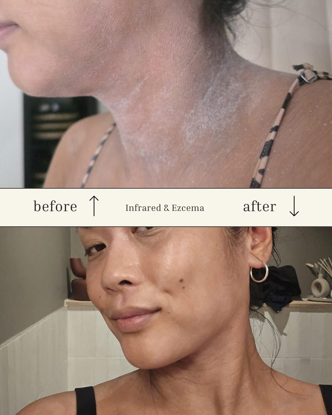 Infrared Sauna for Eczema Relief: A Real Healing Story